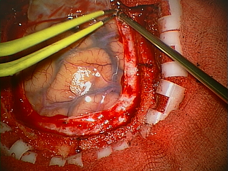 _images/cortex-Craniotomy.png