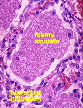 PCP Pathology